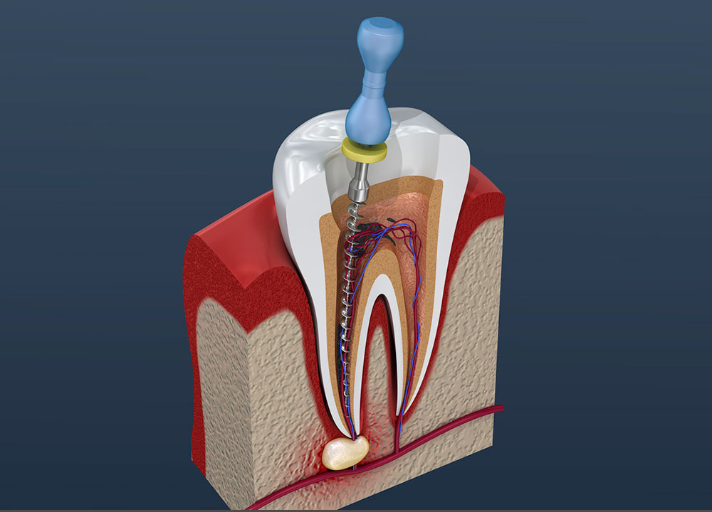 根管治療