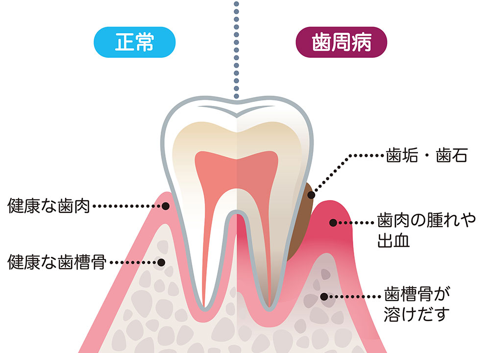 歯周病の原因