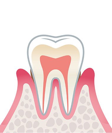 歯周炎（軽度）