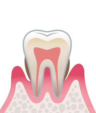 歯周炎（中度）