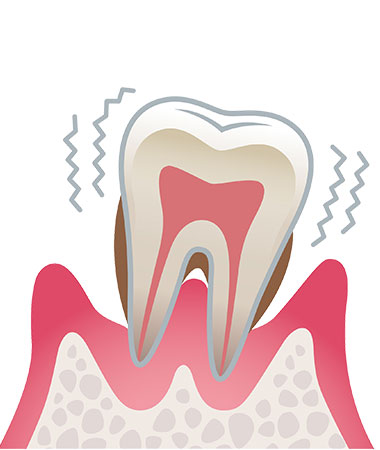 歯周炎（重度）